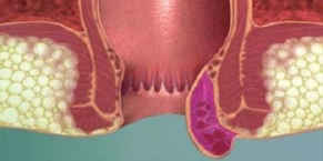 analnaya_mazol_ultra